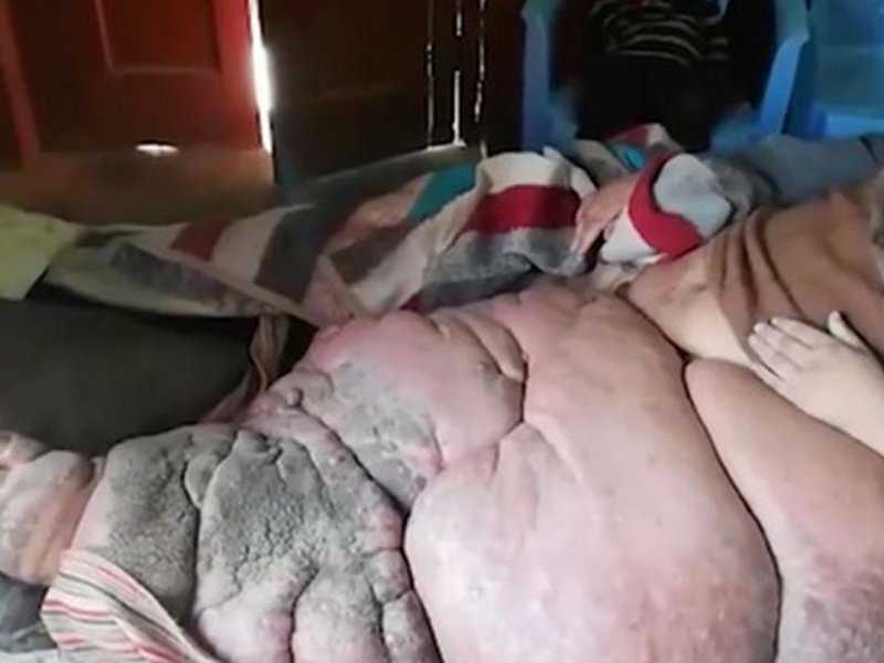 Житель Пакистана молит об ампутации ноги, которая стала весить 150 кг
