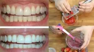Как отбелить зубы клубникой
