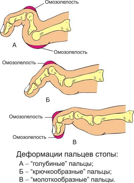 Кривые пальцы на ногах. Как исправить, что делать