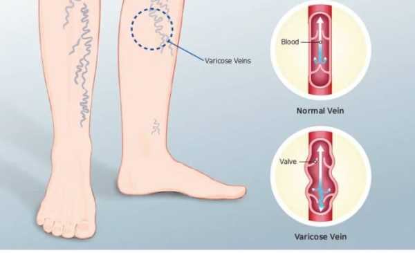 Варикоз: неявные симптомы и методы лечения